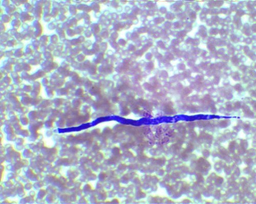 Loa loa là một trong ba loài giun tròn ký sinh trùng gây ra bệnh giun chỉ dưới da ở người. Loài ký sinh trùng xâm nhập vào cơ thể con người thông qua vết cắn của một con ruồi. Nạn nhân trải qua các triệu chứng có thể từ ngứa và đau khớp mệt mỏi đến tử vong.