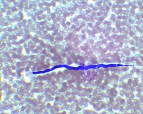 Loa loa là một trong ba loài giun tròn ký sinh trùng gây ra bệnh giun chỉ dưới da ở người. Loài ký sinh trùng xâm nhập vào cơ thể con người thông qua vết cắn của một con ruồi. Nạn nhân trải qua các triệu chứng có thể từ ngứa và đau khớp mệt mỏi đến tử vong.