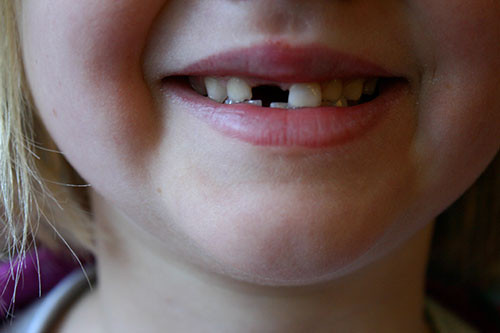 Mơ thấy một cái lỗ trong răng, đó là cảm giác sợ hãi hoặc không an tâm về một tình huống nào đó. Bạn đang thiếu tự tin.