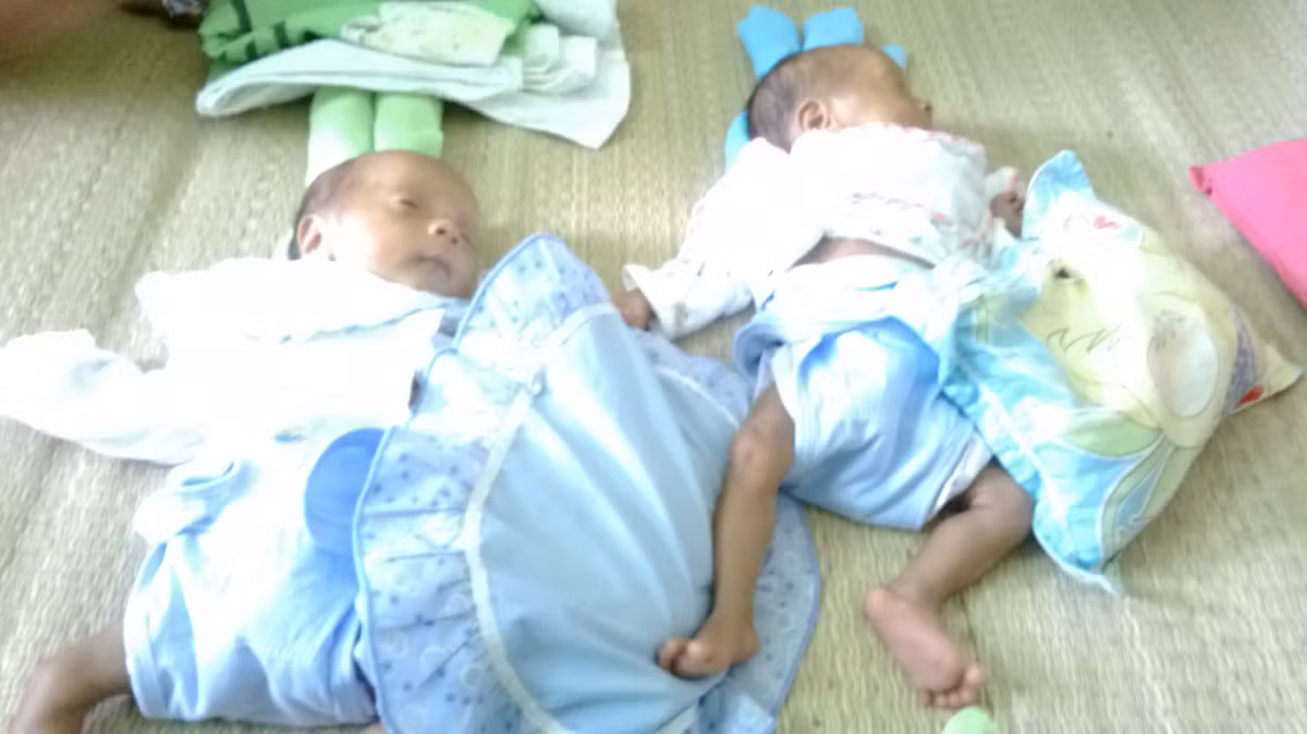 Hai cháu nhỏ bị suy dinh dưỡng nặng..