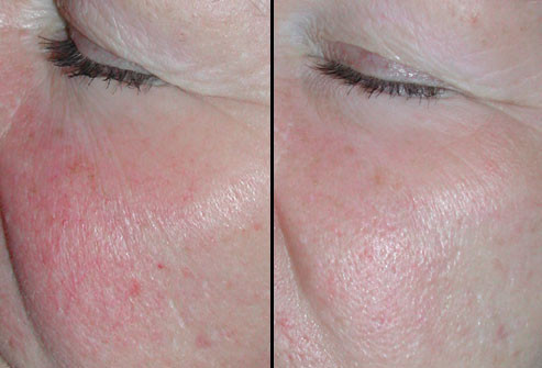 Trước và sau điều trị bằng IPL: IPL có thể làm giảm các chấm đỏ liên quan đến Rosacea (bệnh da mặt tấy đỏ) hay các quầng thâm nhạt dưới mắt do cụm mạch máu dưới da. Một số lần điều trị IPL sẽ làm biến mất các mạch máu, làm lành da. IPL cũng có thể loại bỏ sắc tố không mong muốn (như nám và đốm đồi mồi) bằng cách tiêu diệt các tế bào sắc tố. Cách điều trị này cũng kích thích sản xuất collagen, có thể làm giảm nếp nhăn.