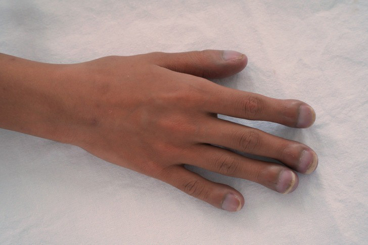 8 “dấu hiệu” bệnh tật nguy hiểm mà chúng ta thường bỏ qua - Hình 4 8 “dau hieu” benh tat nguy hiem ma chung ta thuong bo qua-Hinh-4