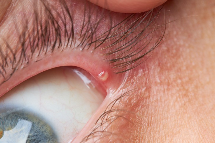 8 “dấu hiệu” bệnh tật nguy hiểm mà chúng ta thường bỏ qua - Hình 6 8 “dau hieu” benh tat nguy hiem ma chung ta thuong bo qua-Hinh-6