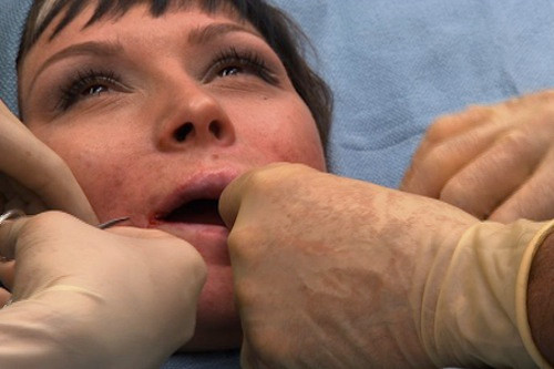 Trong một vài trường hợp, sẽ có phản ứng phụ xảy ra khi cơ địa người bơm môi không phù hợp với đặc tính của các chất làm đầy.