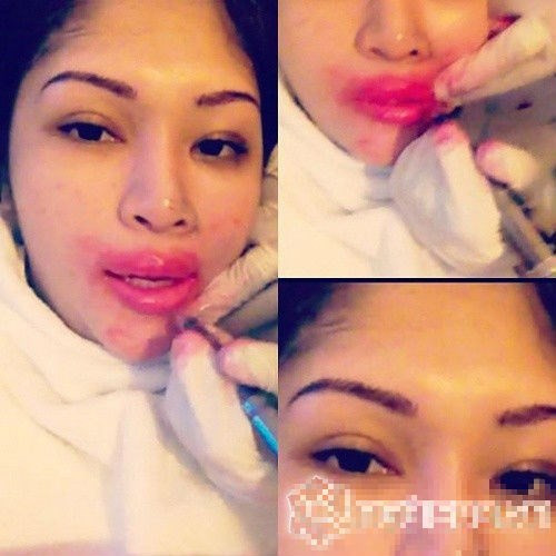 Một người mẫu Thái Lan công khai hình ảnh đôi môi sưng vều do bơm môi.