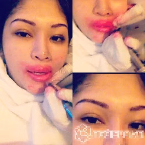 Một người mẫu Thái Lan công khai hình ảnh đôi môi sưng vều do bơm môi.