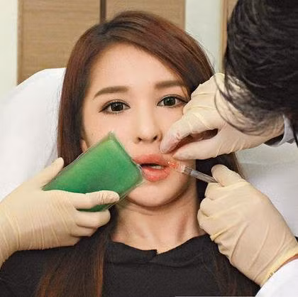 Ở một số trường hợp, khách hàng sẽ được chỉnh hình môi trong quá trình bơm.