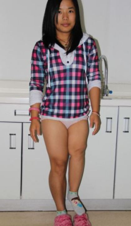 Xu Juan, 21 tuổi, bị nhiễm trùng xương khi cô là một đứa trẻ, và không được điều trị kịp thời khiến xương đùi bị vi khuẩn ăn mòn.