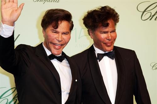 Anh em sinh đôi nhà Igor và Grichka Bogdanoff. Hai anh em sinh đôi nhà Bogdanoff từng là những ngôi sao truyền hình điển trai ở Pháp. Tuy nhiên, sau vô số cuộc phẫu thuật thẩm mỹ, Igor và Grichka Bogdanoff, hiện 60 tuổi, đã gần như biến thành những người khác và có khuôn mặt "không lẫn vào đâu được".