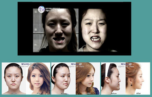 Khuôn mặt của hai chị em song sinh người Hàn Quốc trước và sau phẫu thuật thẩm mỹ.