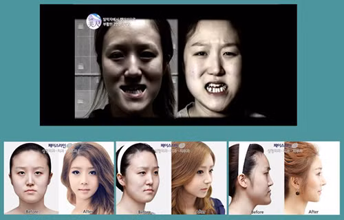 Khuôn mặt của hai chị em song sinh người Hàn Quốc trước và sau phẫu thuật thẩm mỹ.