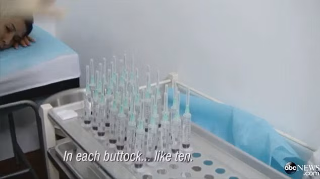 Những ống tiêm sử dụng chất độn để tiêm vào vòng 3 của Sofia.