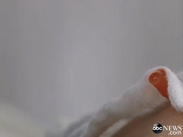 Chất bio-polymer rỉ ra từ chỗ tiêm vào cơ thể Sofia.