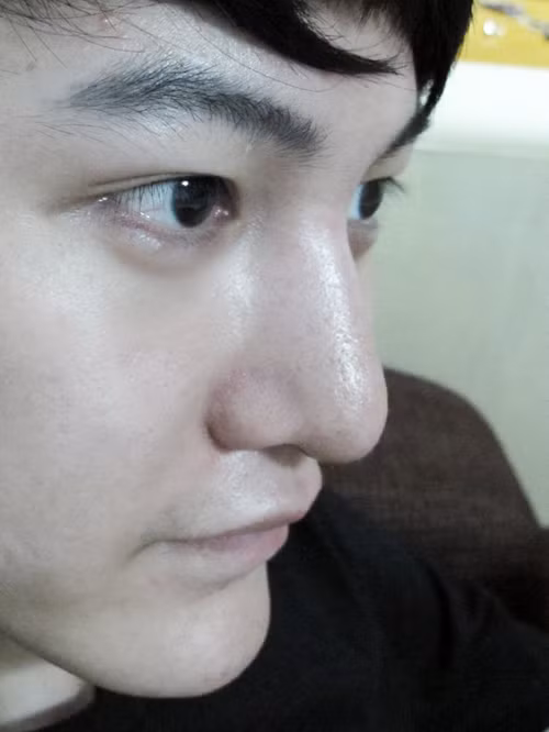 Anh chàng này đã có chiếc mũi cao thon gọn, cằm v-line như ý sau khi nâng mũi và độn cằm.