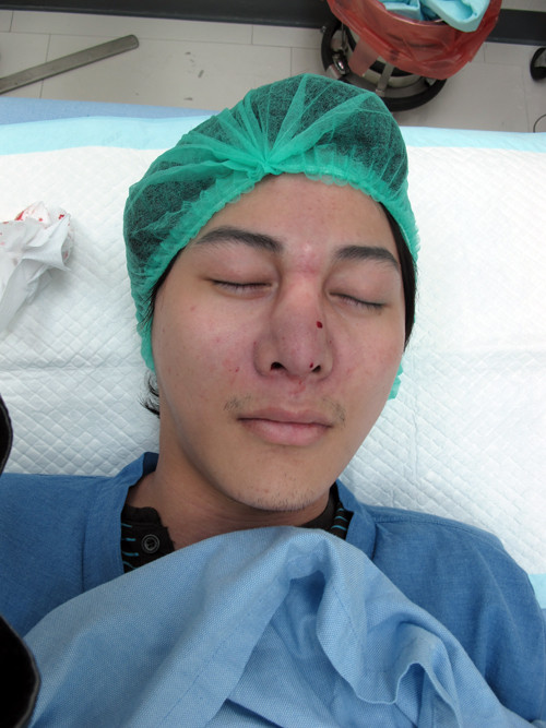 Khuôn mặt sưng vù sau khi nâng mũi.