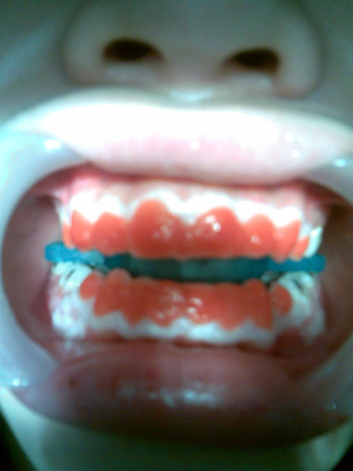 Cuối cùng, chàng trai này đã quyết định phẫu thuật thẩm mỹ. Chàng trai trẻ đã nhờ đến dao kéo để chỉnh sửa hầu hết các bộ phận trên khuôn mặt như cắt mí, độn cằm, tạo má lúm đồng tiền, nâng mũi, sửa môi dưới.