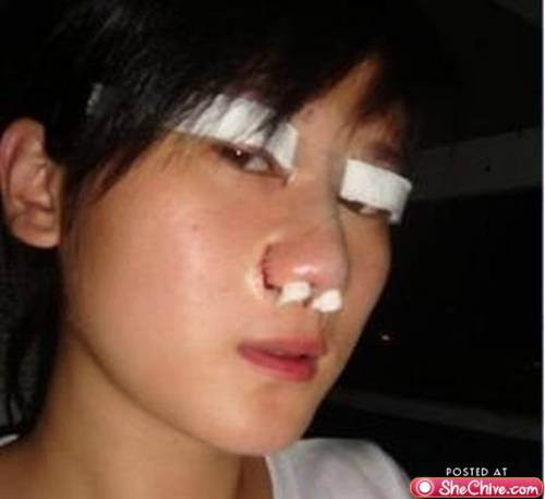 Một cô gái giấu tên người Trung Quốc cũng bị hỏng mí mắt vì quyết tâm dùng dao kéo để có được vẻ đẹp hoàn hảo hơn.