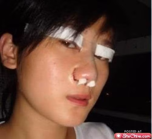 Một cô gái giấu tên người Trung Quốc cũng bị hỏng mí mắt vì quyết tâm dùng dao kéo để có được vẻ đẹp hoàn hảo hơn.