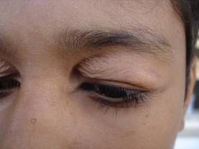 Phẫu thuật mắt cũng để lại nhiều biến chứng như: những vết nhăn li ti không biến mất. Những đường nhăn khi cười vẫn còn mí mắt sâu, xuất huyết, mắt nhắm không kín, hai mí mắt trên không cân...