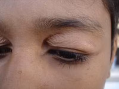 Phẫu thuật mắt cũng để lại nhiều biến chứng như: những vết nhăn li ti không biến mất. Những đường nhăn khi cười vẫn còn mí mắt sâu, xuất huyết, mắt nhắm không kín, hai mí mắt trên không cân...