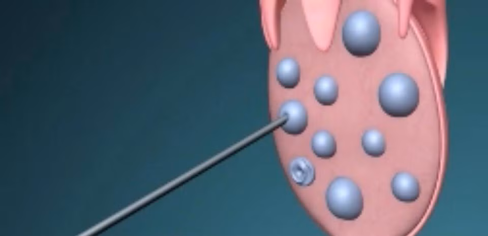 ...khi nang noãn đã được trưởng thành, chúng sẽ được hút ra