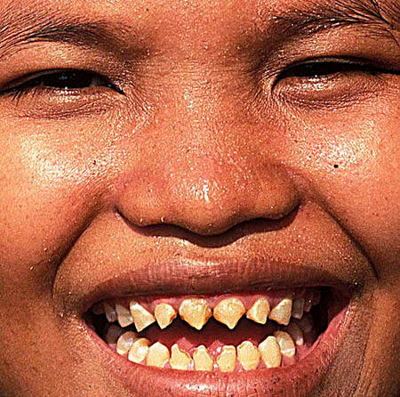 Phụ nữ tại một số khu nông thôn ở Indonesia được xem là vô cùng xinh đẹp sau khi trải qua quá trình mài nhọn răng.