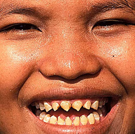 Phụ nữ tại một số khu nông thôn ở Indonesia được xem là vô cùng xinh đẹp sau khi trải qua quá trình mài nhọn răng.