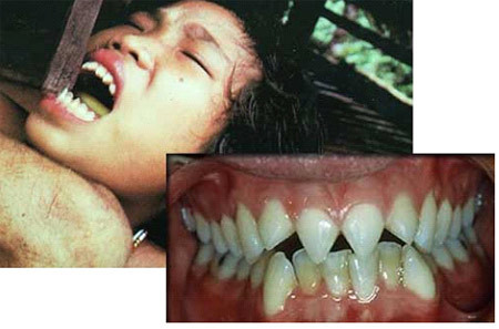 Sau khi hoàn thành, hàm răng cô gái sẽ giống như những mũi nhọn hoắt, gần giống như răng cá mập.