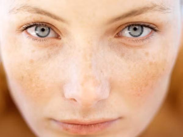 Nám da là một hội chứng phức tạp. Ðó là những đốm nụm đỏ lan tỏa dần trên má, trên mũi. Dần dần về sau, những mạch máu li ti xuất hiện tạo thành vết màu đỏ kém thẩm mỹ trên da mặt.