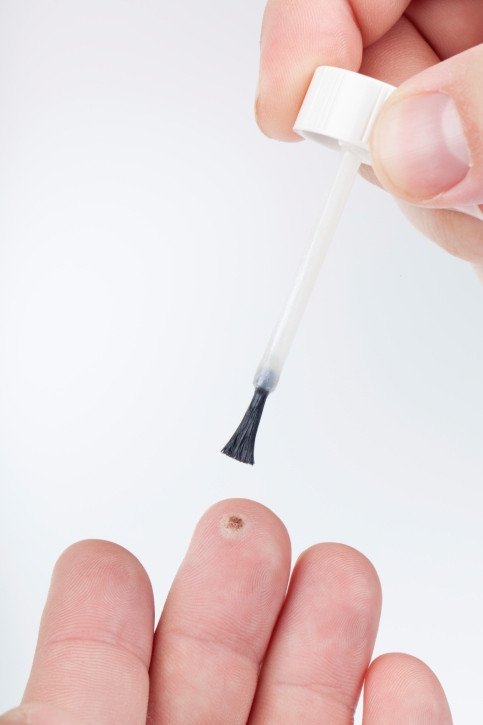 Có rất nhiều phương pháp điều trị khác nhau để loại bỏ mụn cóc. Bạn cũng có thể sử dụng một số biện pháp khắc phục tại nhà tự nhiên để loại bỏ mụn cóc như dùng tỏi, dầu cây trà, dầu hạt điều...Nếu tình trạng nặng hơn bạn phải cần đến sự trợ giúp của bác sĩ da liễu.