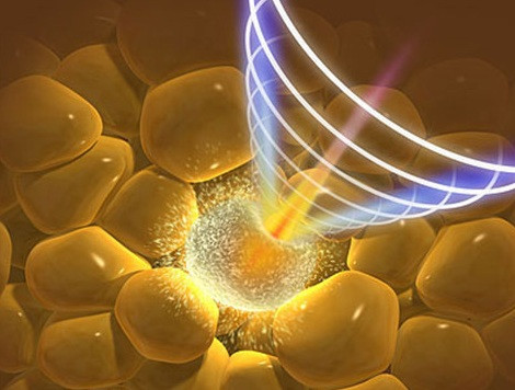 Hút mỡ bằng tia laser. Việc hút mỡ bằng tia laser, khi mới nghe qua sẽ khiến không ít người trầm trồ và cho rằng đây là 1 phát kiến vượt bậc của ngành công nghiệp phẫu thuật thẩm mỹ. Tuy nhiên kèm theo đó là những mối hồ nghi có cơ sở của nhiều bác sĩ tư vấn sắc đẹp lành nghề.