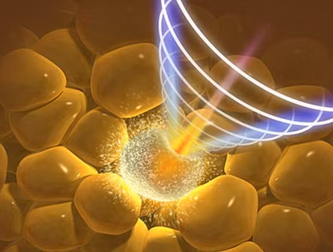 Hút mỡ bằng tia laser. Việc hút mỡ bằng tia laser, khi mới nghe qua sẽ khiến không ít người trầm trồ và cho rằng đây là 1 phát kiến vượt bậc của ngành công nghiệp phẫu thuật thẩm mỹ. Tuy nhiên kèm theo đó là những mối hồ nghi có cơ sở của nhiều bác sĩ tư vấn sắc đẹp lành nghề.