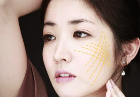 Căng da mặt bằng chỉ. Kỹ thuật căng da này ứng dụng chỉ căng da Ultra V Lift, bác sĩ Hàn Quốc sẽ thực hiện luồn chỉ nâng các lớp da thừa, chùng nhão chảy xệ trên mặt, kéo căng tổ chức mô đệm đỡ dưới da nhằm tăng cường tối đa độ căng da và săn chắc cơ trên mặt và cổ hay các vùng da nhăn mà không làm tổn thương thần kinh, an toàn, không mất nhiều thời gian nghỉ dưỡng.