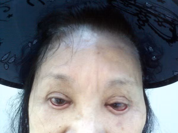 Đôi mắt bị biến dạng, sụp nghiêm trọng do hậu quả của cắt mí, hút mỡ bọng mắt.