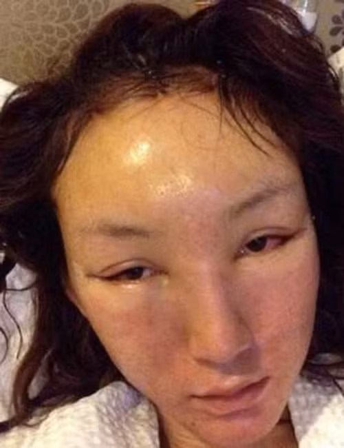 Đôi mắt sưng vù do vết cắt mí mắt gây ra của nữ diễn viên người Trung Quốc.