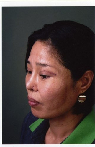 Vết sẹo khó mà xóa mờ do can thiệp dao kéo cắt mí mắt.