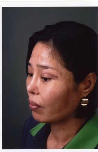 Vết sẹo khó mà xóa mờ do can thiệp dao kéo cắt mí mắt.