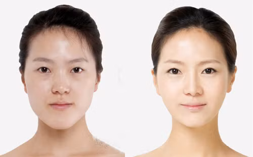 Hình ảnh khuôn mặt thon gọn hơn sau phẫu thuật gọt mặt.