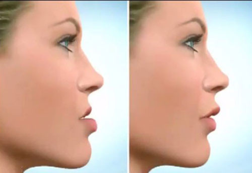 Phẫu thuật độn cằm cùng được sử dụng trong một số trường hợp hô hàm dưới, cằm lẹm bẩm sinh để khuôn mặt cân đối hơn.