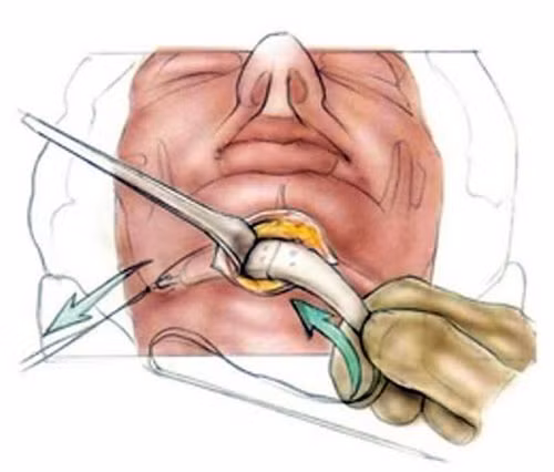 Có hai loại phẫu thuật độn cằm phổ biến nhất là; Rạch từ ngoài : Với phương pháp này, bác sĩ phẫu thuật sẽ rạch một đường phía ngoài da rồi nhét miếng silicone vào bên trong. Cách này đơn giản hơn nhưng có thể để lại sẹo ẩn lâu dài.