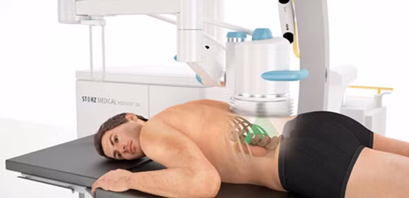 Tán sỏi ngoài cơ thể: Bạn sẽ được hướng dẫn không ăn hoặc uống bất cứ điều gì ít nhất 12 giờ trước khi tán sỏi. Mặc quần áo thoải mái để bạn có thể thay đổi dễ dàng thành một chiếc áo choàng phẫu thuật để phẫu thuật. Thời gian tán sỏi có thể mất khoảng một giờ. Bạn được giảm đau với thuốc an thần để giảm thiểu đau đớn và khó chịu . Có thể có cảm giác khó chịu hoặc đau nhẹ trong khi tiến hành.