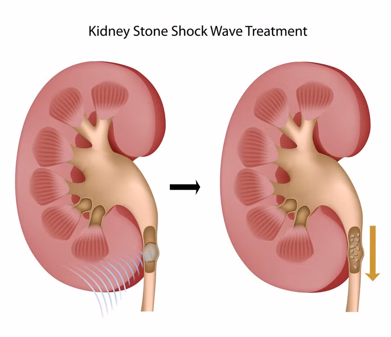 Tán sỏi được thực hiện nếu kích thước sỏi lớn, có hình dạng bất thường hoặc là bị mắc kẹt trong niệu quản và không thể được thông qua trong khi đi tiểu. Chỉ định tán sỏi dựa vào việc xem xét kích thước, vị trí, hình dạng và số lượng sõi trong các cơ quan tiết niệu.