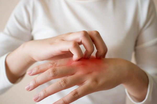 Ba trieu chung tren da canh bao gan nhiem mo