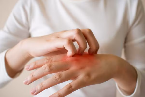 Ba trieu chung tren da canh bao gan nhiem mo