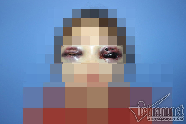 Cat mi tai spa, co gai Ha Noi mu 1 mat, ben con lai rat mo