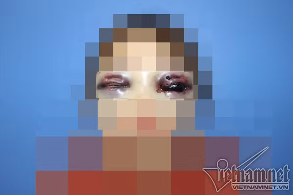 Cat mi tai spa, co gai Ha Noi mu 1 mat, ben con lai rat mo