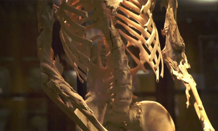 Có một căn bệnh di truyền được gọi là Hội chứng FOP (Fibrodysplasia Ossificans Progressiva) hay chứng vôi hóa các cơ khớp. Đây là một dạng bệnh rất hiếm gặp, làm cho nhiều phần cơ thể hóa thành xương sau khi bị tổn thương. Những người mắc căn bệnh này phải phải lựa chọn đứng hoặc ngồi trong suốt phần đời còn lại của họ. Vào cuối đời, họ chỉ có dùng ống hút để uống các bữa ăn và hầu như không thể di chuyển.