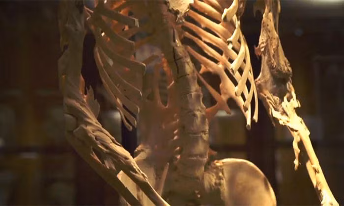 Có một căn bệnh di truyền được gọi là Hội chứng FOP (Fibrodysplasia Ossificans Progressiva) hay chứng vôi hóa các cơ khớp. Đây là một dạng bệnh rất hiếm gặp, làm cho nhiều phần cơ thể hóa thành xương sau khi bị tổn thương. Những người mắc căn bệnh này phải phải lựa chọn đứng hoặc ngồi trong suốt phần đời còn lại của họ. Vào cuối đời, họ chỉ có dùng ống hút để uống các bữa ăn và hầu như không thể di chuyển.