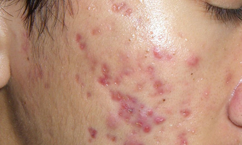 Các nhà khoa học tin rằng, có mối liên hệ giữa mụn và mối nguy ung thư tiền liệt tuyến.