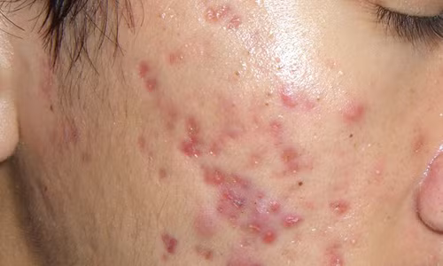 Các nhà khoa học tin rằng, có mối liên hệ giữa mụn và mối nguy ung thư tiền liệt tuyến.